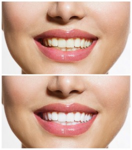 whitening